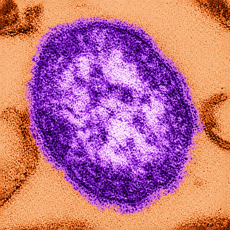 MEASLES